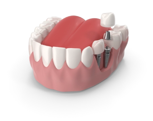 Dr Expedito Carlos - RJ // Tratamento de implantes dentários RJ